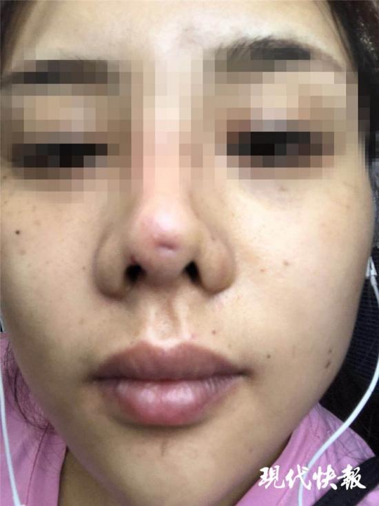  假体滑出鼻尖 90后姑娘隆鼻整成了猪鼻子